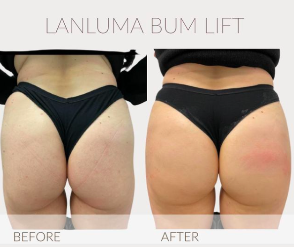Enhance Me - Permanent Cosmetics & Aesthetics - Hip Dip Filler🍑 A  specialist Dermal Filler is inserted via a cannula into the buttock towards  to hip area to reduce hip dips by