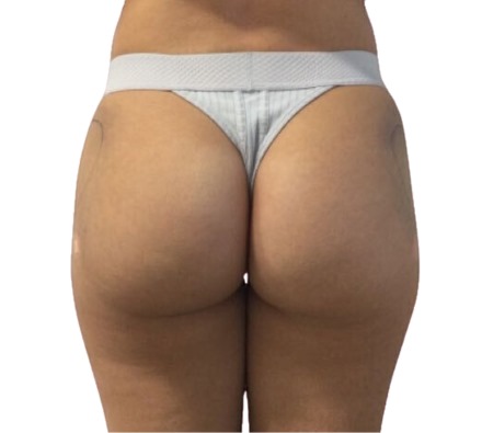 Lanluma Bum Lift Before and After