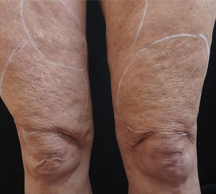 Legs before and after Morpheus8 treatment. Individual results may vary.