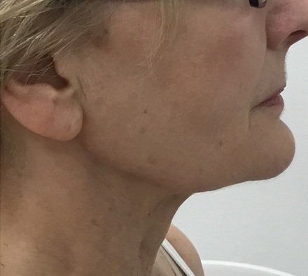 Ultherapy Before and After Jowls