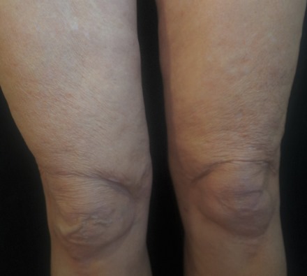 Legs before and after Morpheus8 treatment. Individual results may vary.
