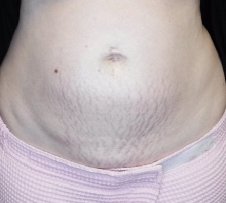 Stomach before and after Morpheus8 treatment. Individual results may vary.