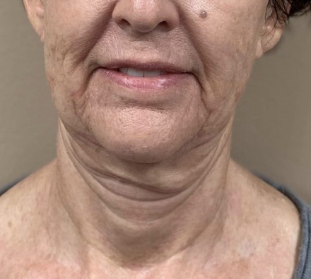 Neck before and after Morpheus8 treatment. Individual results may vary.
