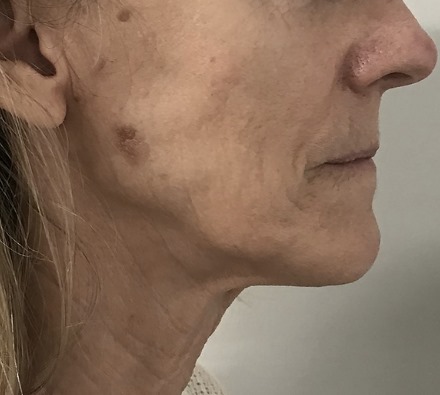 Lower face before and after Morpheus8 treatment. Individual results may vary.