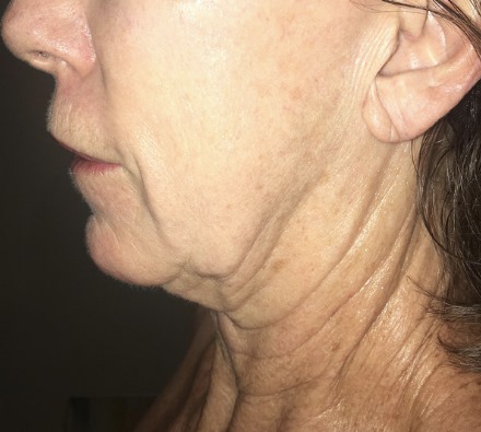 Neck before and after Morpheus8 treatment. Individual results may vary.