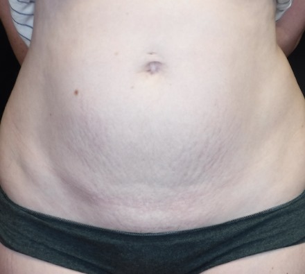 Stomach before and after Morpheus8 treatment. Individual results may vary.