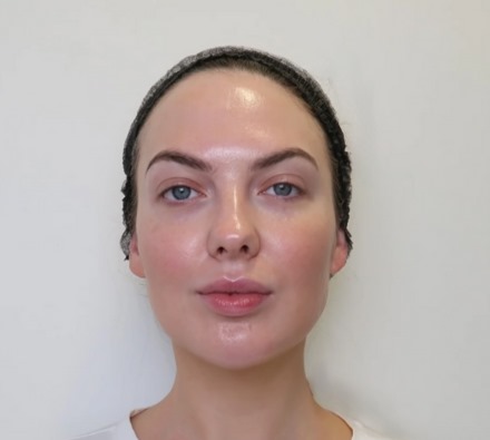 Glass Skin Peel at Dr. Leah Clinics