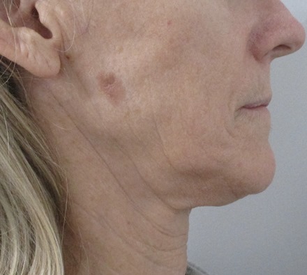 Lower face before and after Morpheus8 treatment. Individual results may vary.