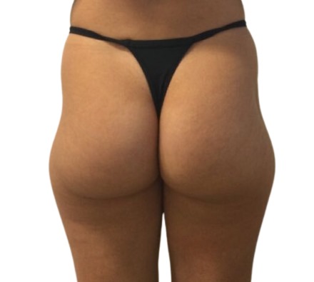 Lanluma Bum Lift Before and After