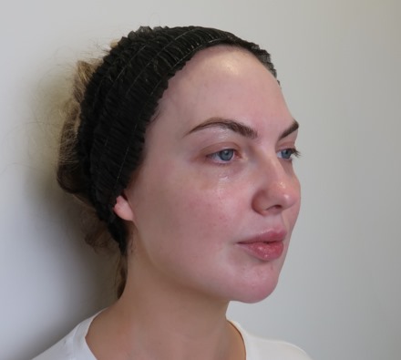 Glass Skin Peel at Dr. Leah Clinics