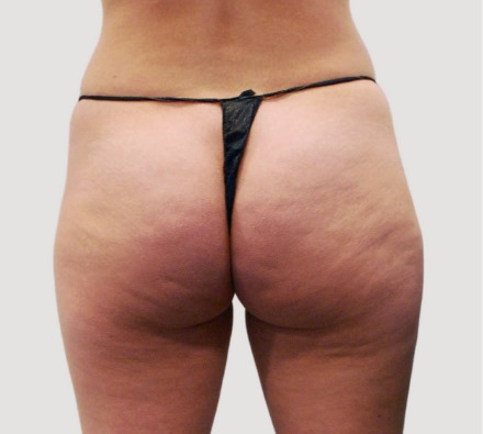 https://www.drleah.co.uk/images/beforeafter-page/df759b91-062e-4753-9ea4-8272d4a2dc63/lanluma-bum-lift-before-and-after--2-vials-4-weeks-apart-.jpg